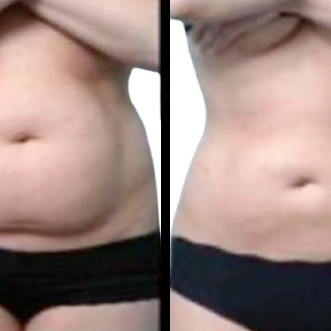 HD Lipo waistline before and after result